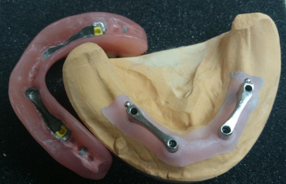 Способы фиксации зубного протеза на имплантах