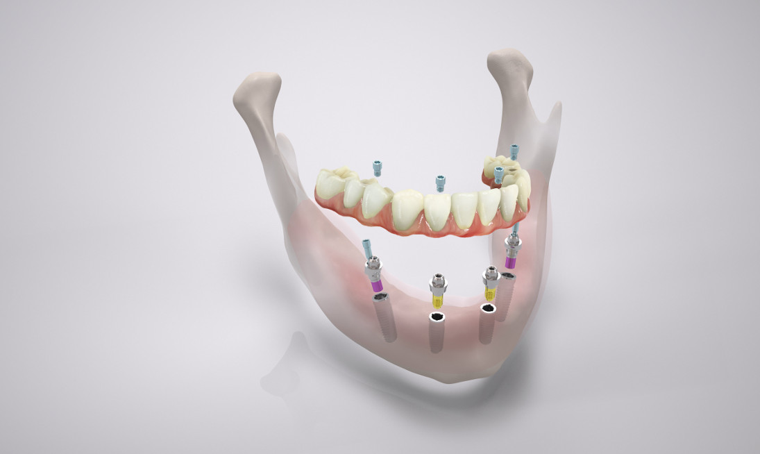 Протез на 4 имплантах: показания и противопоказания к технологии.