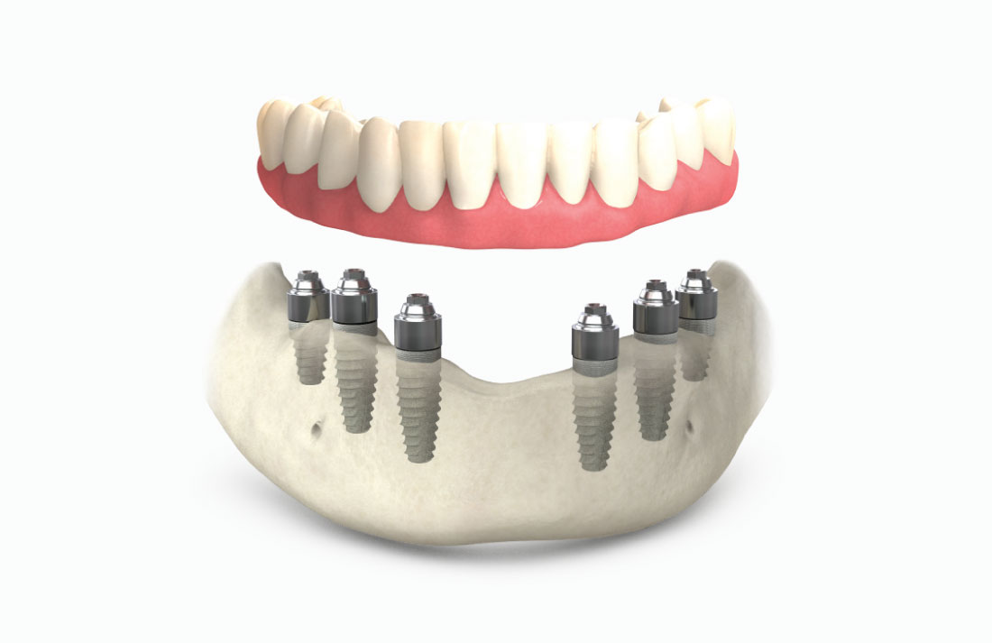 All-on-6: имплантация с установкой протеза.